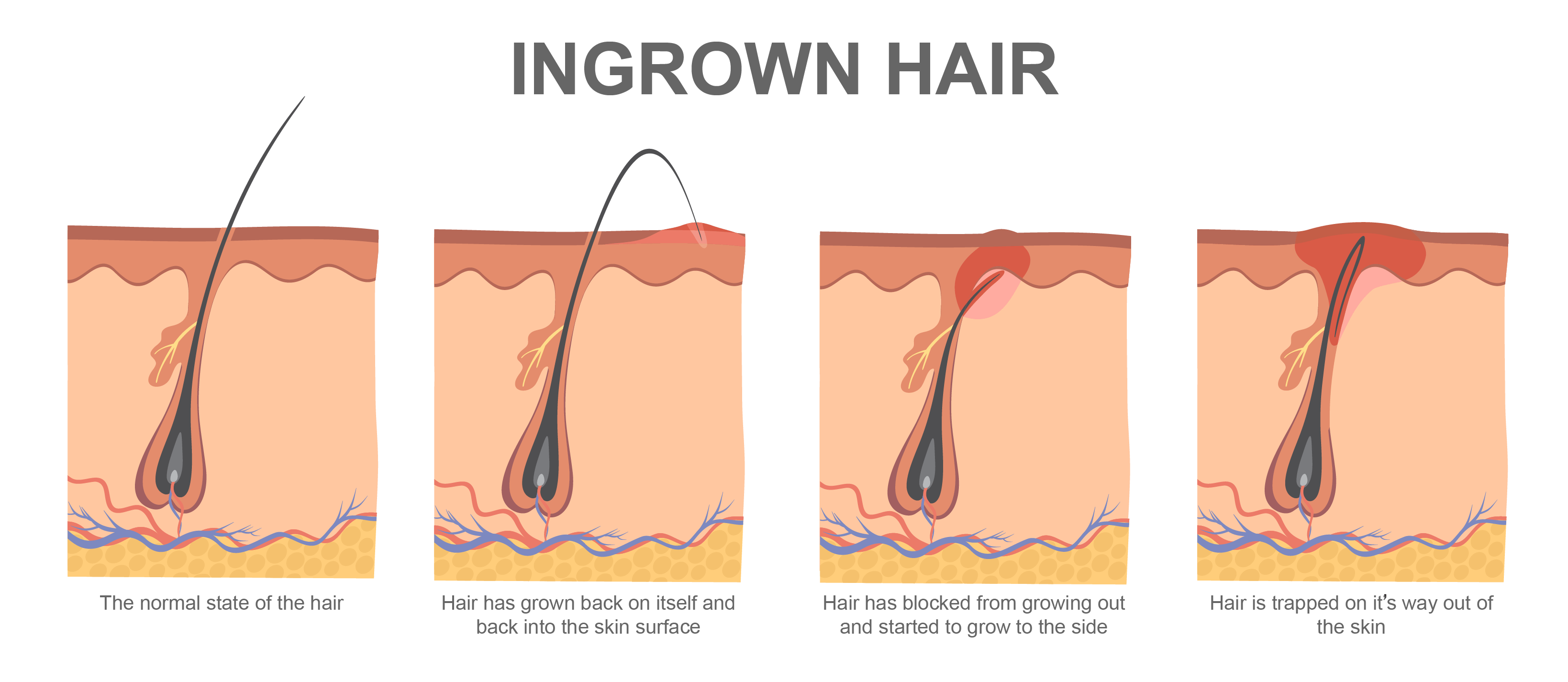 How to Get Rid of Ingrown Hairs