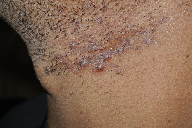 inflamed hair follicle on shaft