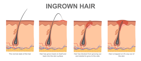 Cause of Ingrown Hairs 